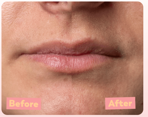 Split-screen comparison of lips: "Before" showing dry, textured skin and "After" showing smooth, hydrated lips.