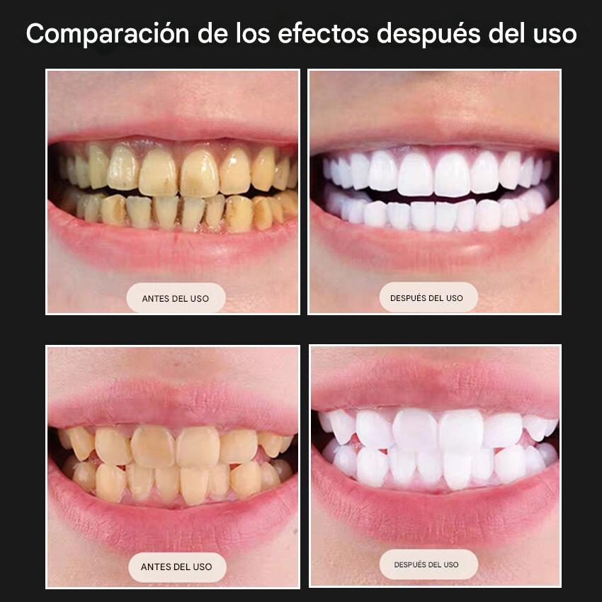 Comparativa visual de antes y después del blanqueamiento dental mostrando dientes más blancos y brillantes.